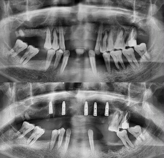 Full Mouth Dental Implants