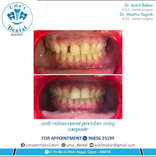 Composite Bonding & Gap Closure