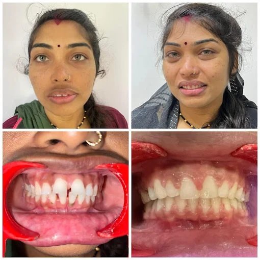 Full Arch Smile Reconstruction