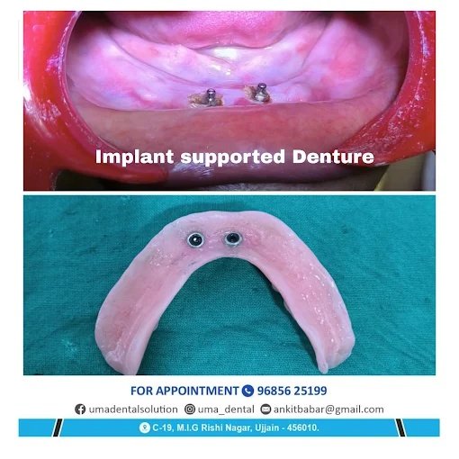 Implant-Supported Overdenture