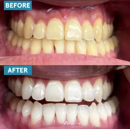Professional Teeth Whitening