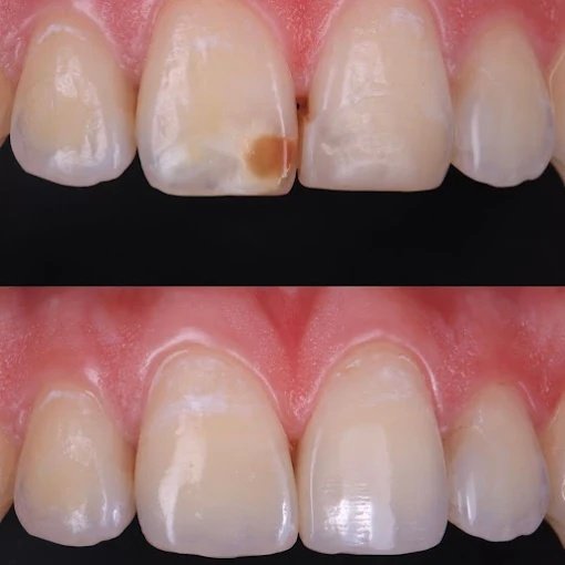 Enamel Microabrasion & Resin Infiltration