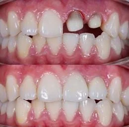 Single Tooth Aesthetic Crown Restoration
