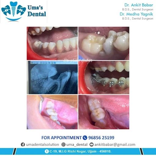 Molar Uprighting & Orthodontic Alignment