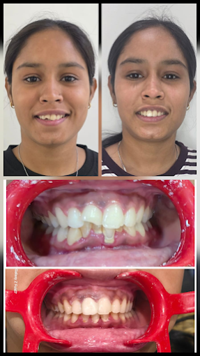 Broken Incisor Repair & Alignment